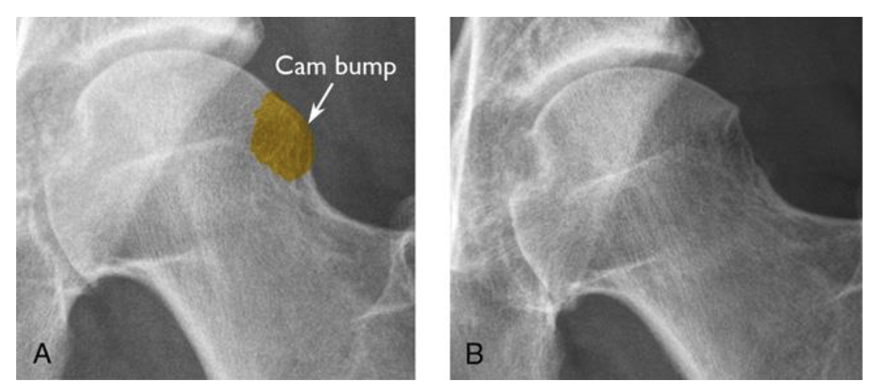 Импиджмент синдром тазобедренный сустав. Cam импинджмент тазобедренного сустава рентген. Остеофиты головки бедренной кости. Остеофиты тазобедренного сустава рентген.